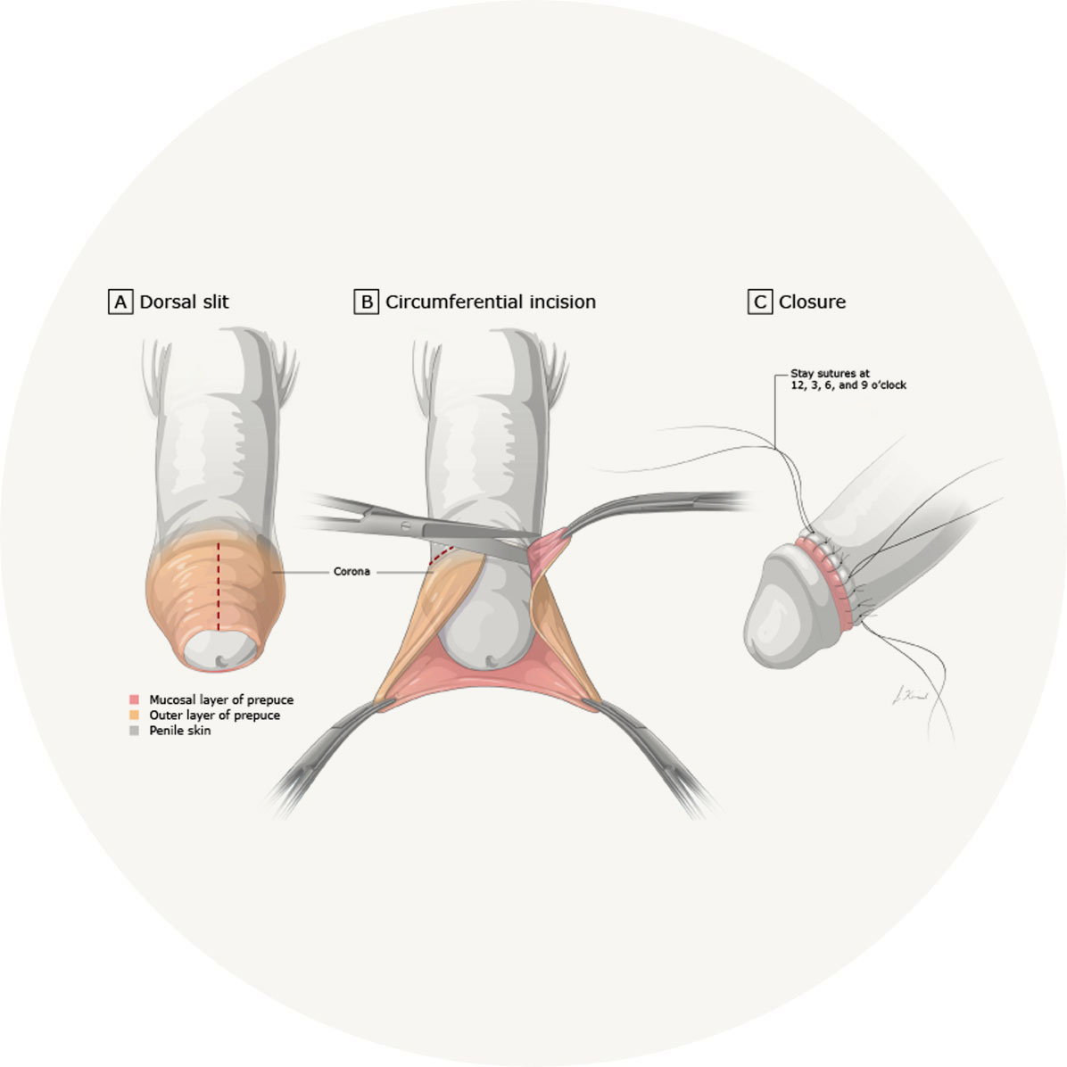 What will happen during the procedure?